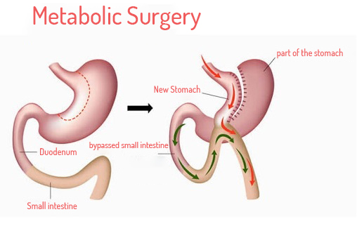 Metobolic Surgery