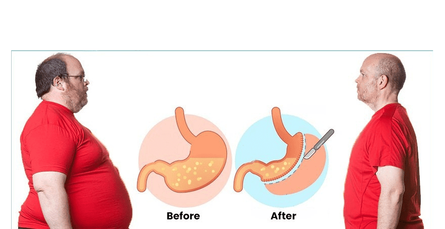 What is Weight Loss Surgery
